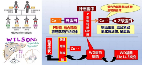 铜娃娃-肝豆状核变性 定稿1.17646.png