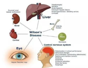 铜娃娃-肝豆状核变性 定稿1.171034.png